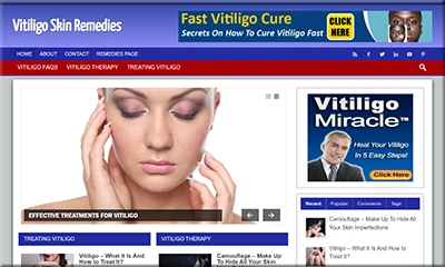 Ready Made Vitiligo Website at a Reduced Price